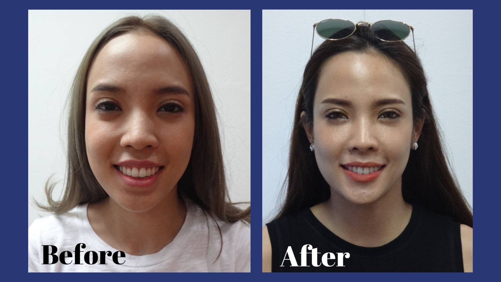 รีวิว จัดฟันแบบใส คุณนาฏวรางค์ จั่นเพียร