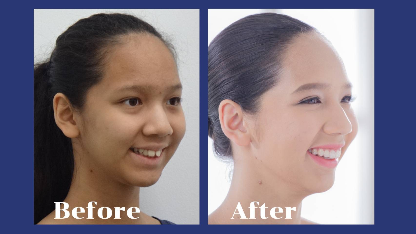 รีวิว จัดฟันแบบใส คุณอนัศญา  เศรษจันทร์