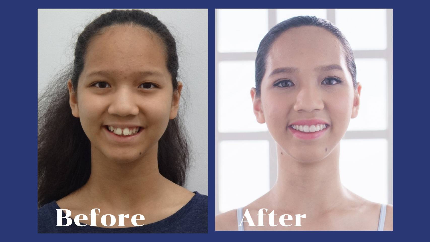 รีวิว จัดฟันแบบใส คุณอนัศญา  เศรษจันทร์