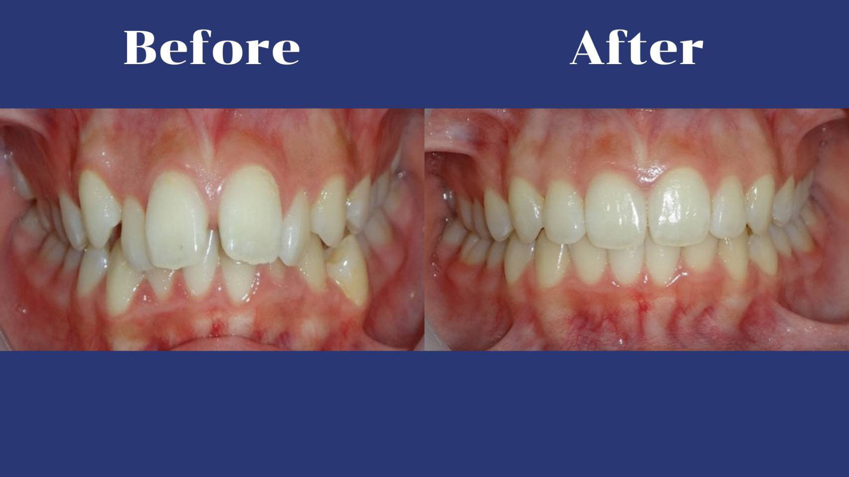 รีวิว จัดฟันแบบใส คุณอนัศญา  เศรษจันทร์