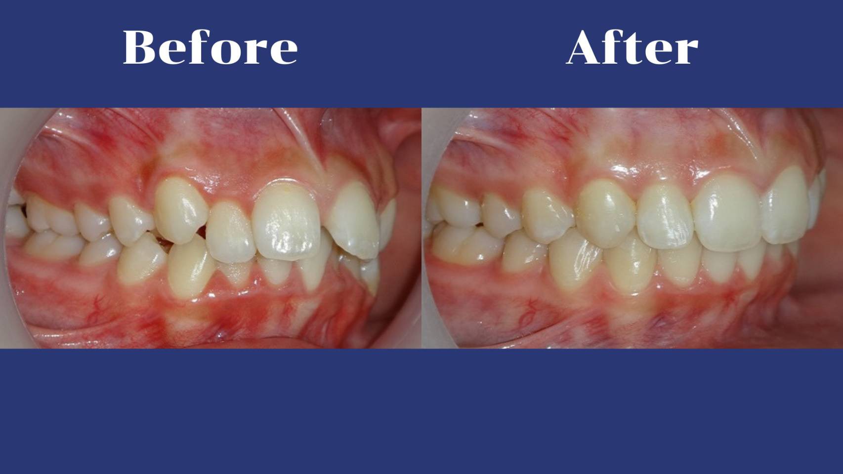 รีวิว จัดฟันแบบใส คุณอนัศญา  เศรษจันทร์