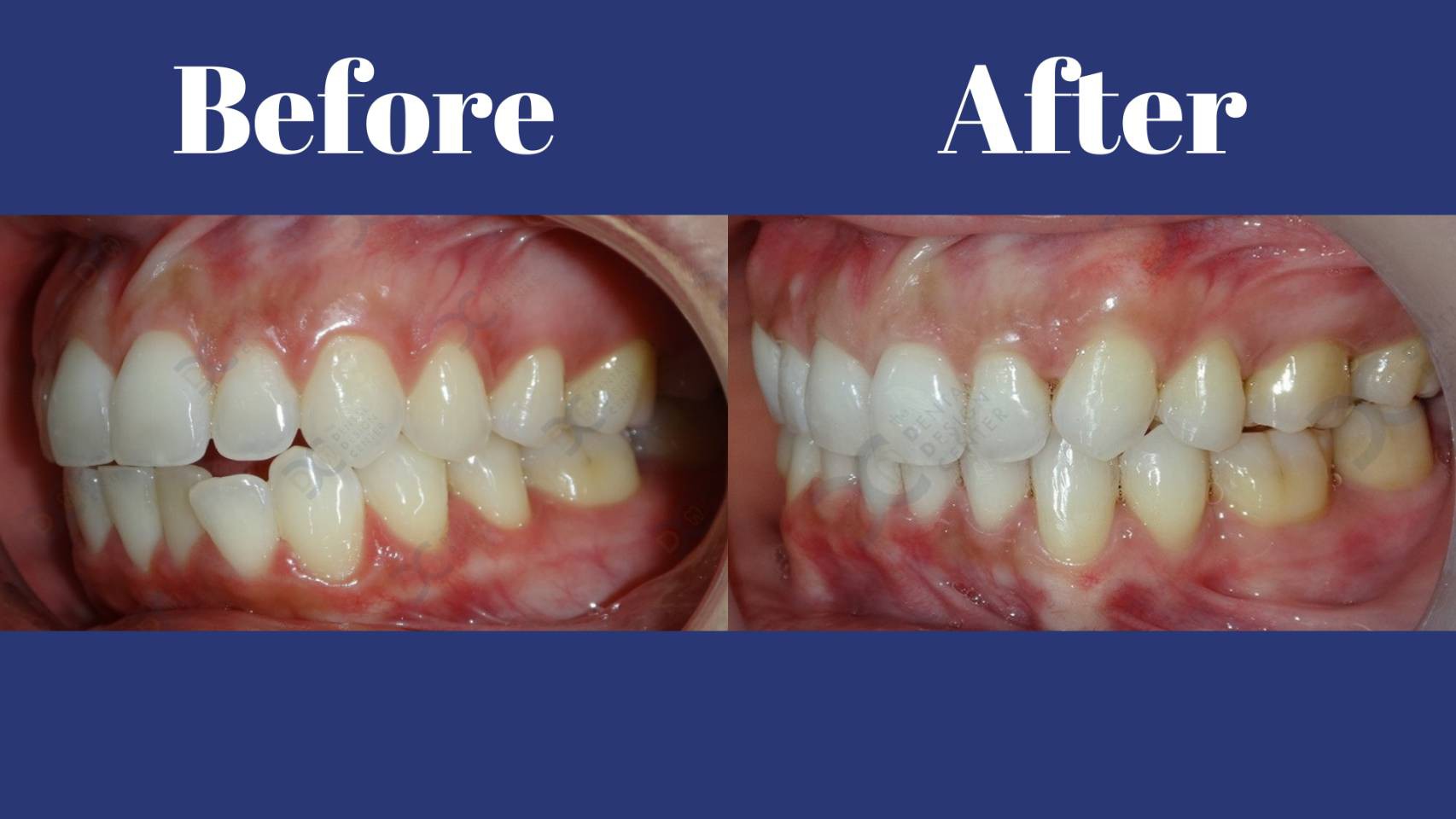 รีวิว จัดฟันแบบใส คุณนาฏวรางค์ จั่นเพียร