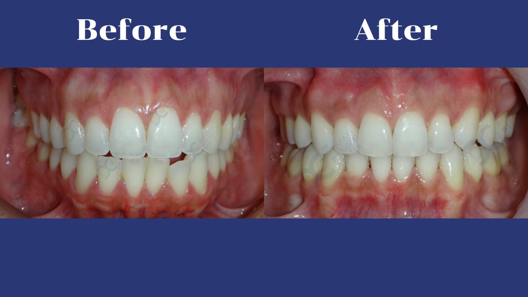 รีวิว จัดฟันแบบใส คุณนาฏวรางค์ จั่นเพียร