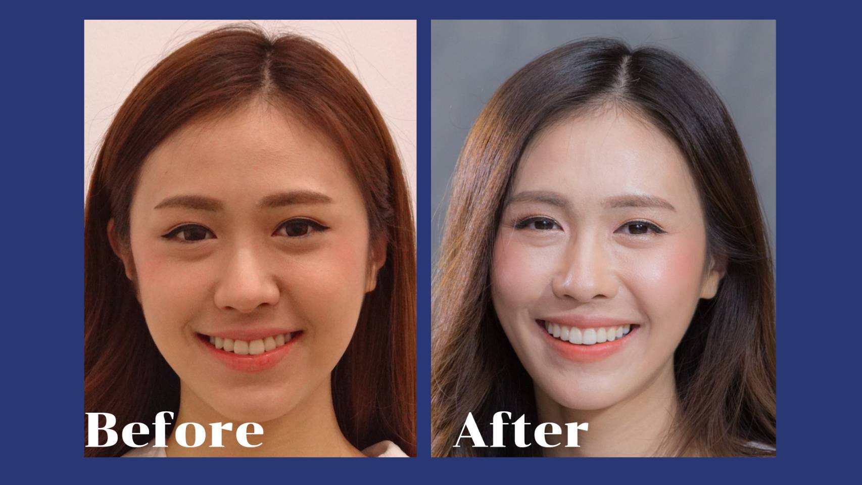 รีวิว จัดฟันแบบใส คุณอภิสรา ทัตติ