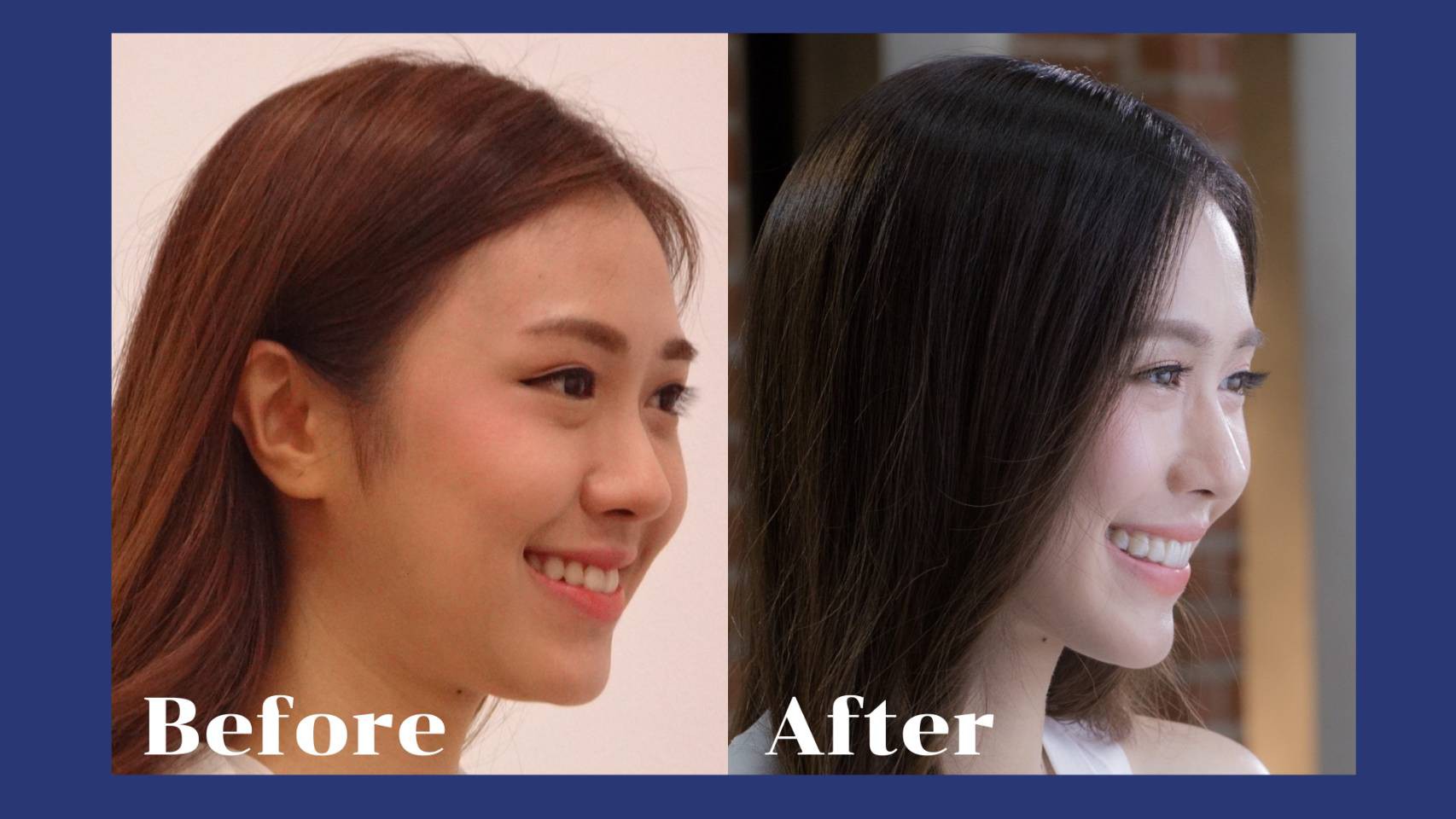 รีวิว จัดฟันแบบใส คุณอภิสรา ทัตติ