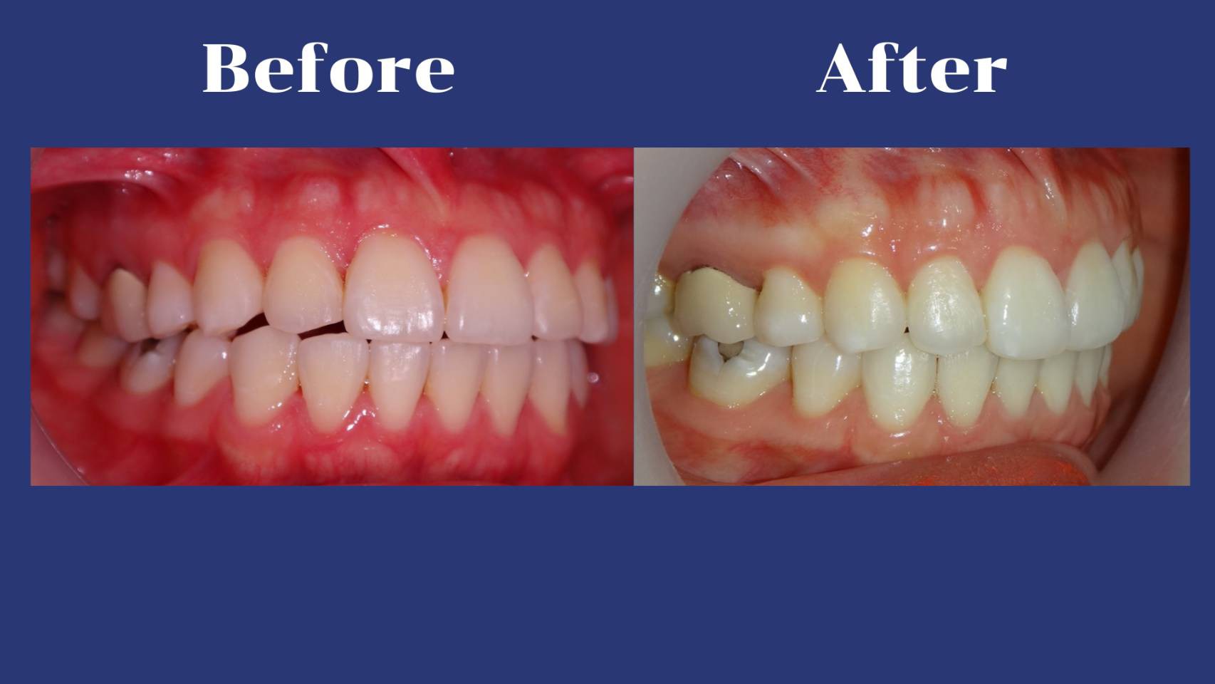 รีวิว จัดฟันแบบใส คุณอภิสรา ทัตติ