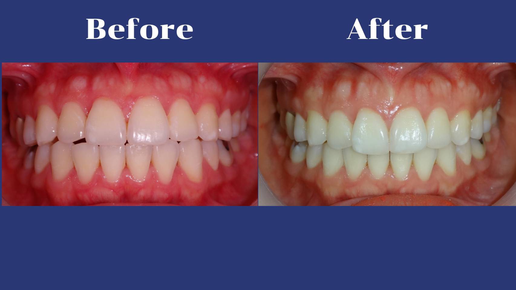 รีวิว จัดฟันแบบใส คุณอภิสรา ทัตติ
