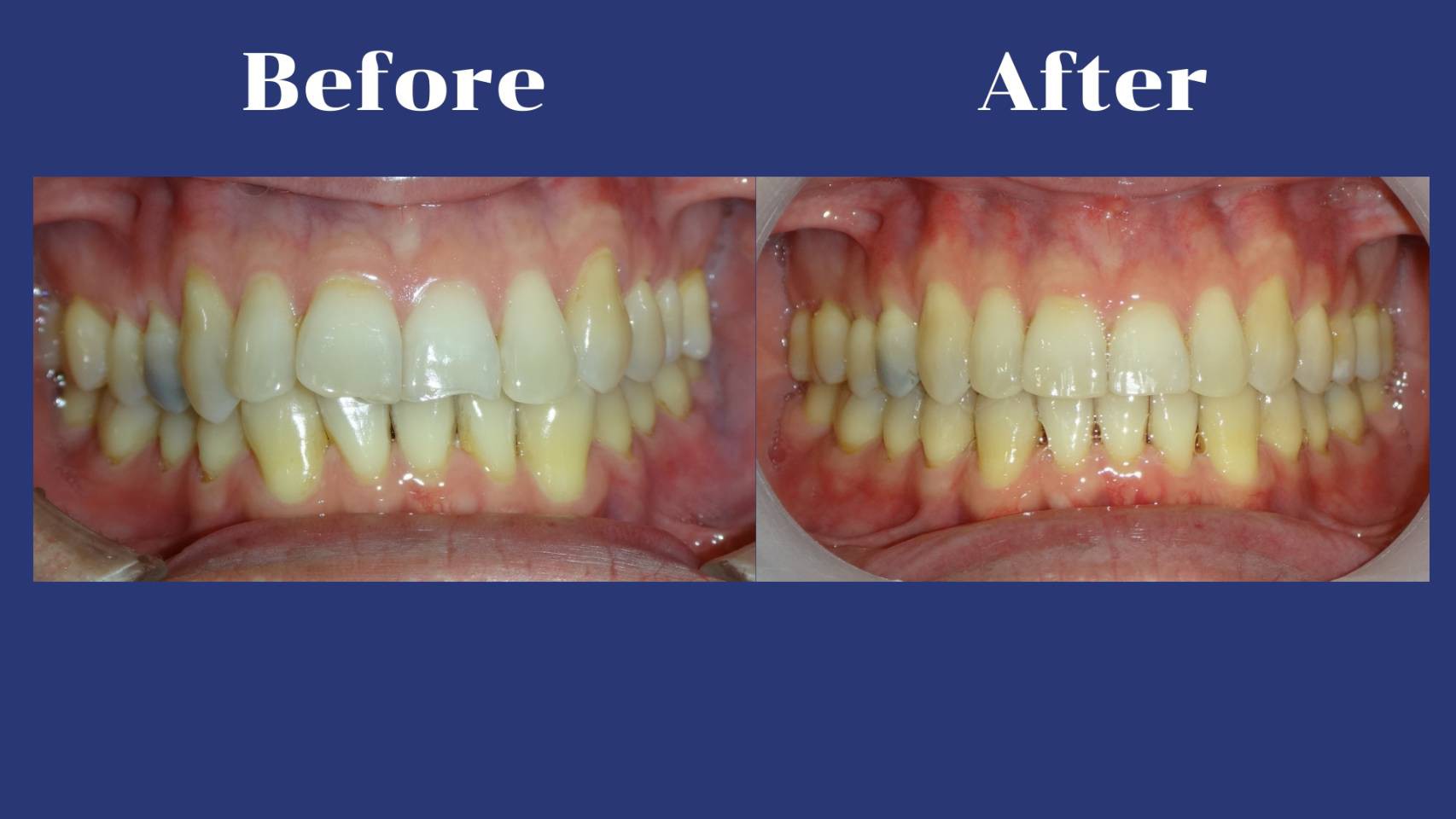 รีวิว จัดฟันแบบใส รศ.ดร.คงธวัช ชัยรัชวิทย์