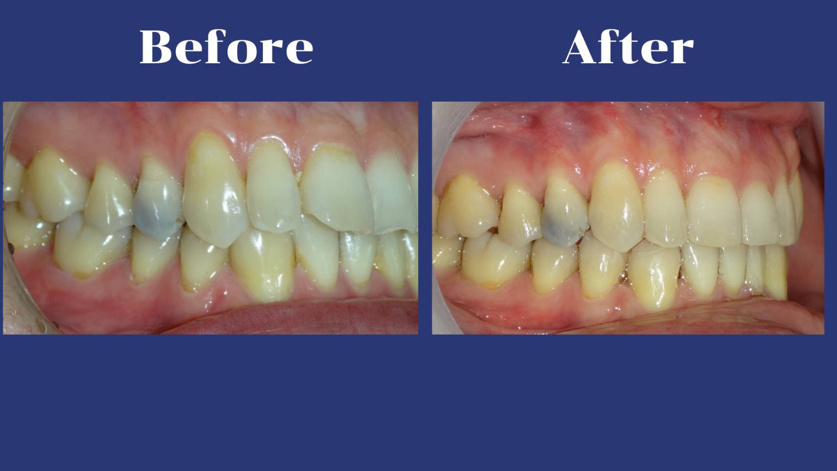 รีวิว จัดฟันแบบใส รศ.ดร.คงธวัช ชัยรัชวิทย์