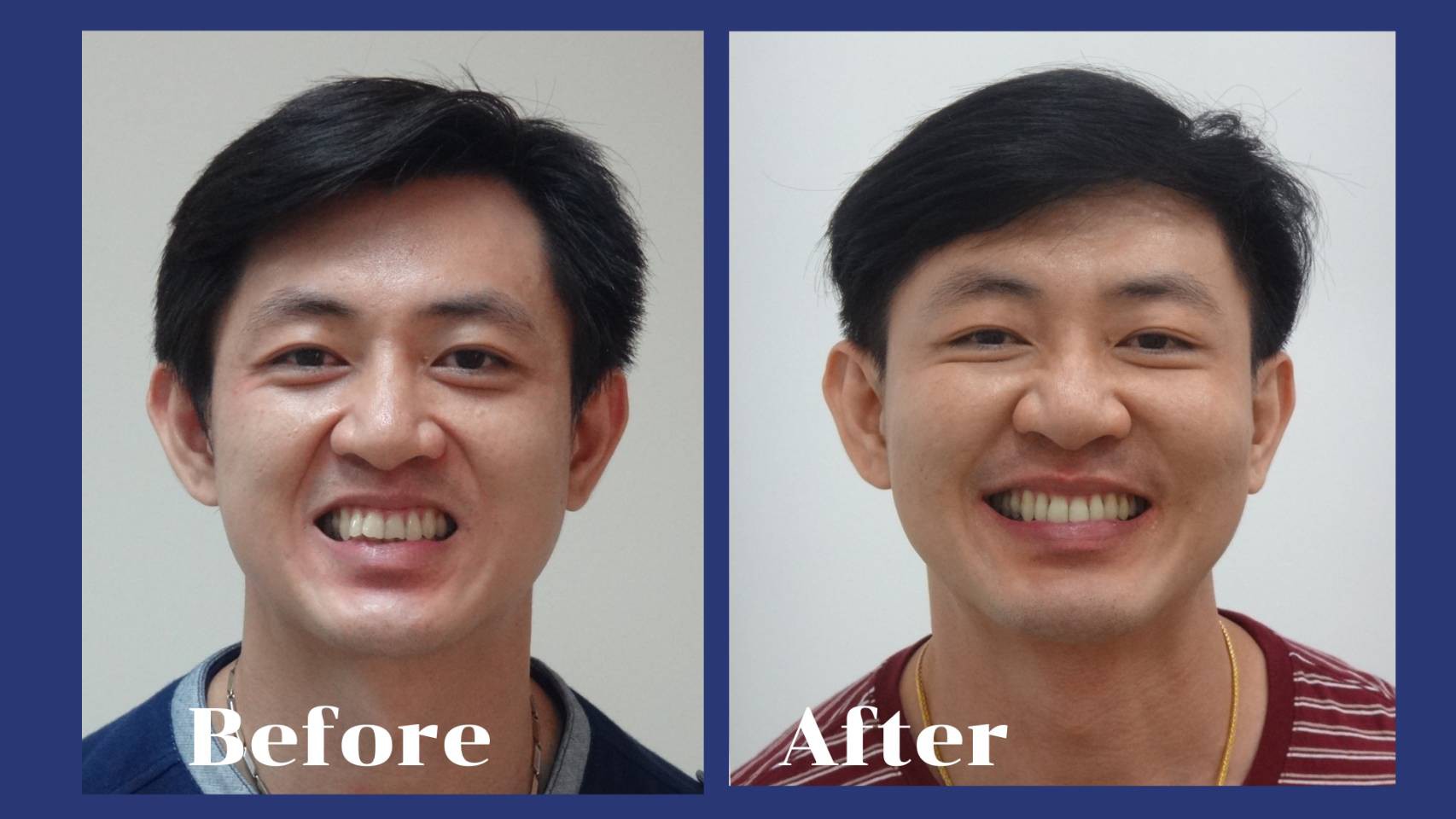 รีวิว จัดฟันแบบใส รศ.ดร.คงธวัช ชัยรัชวิทย์